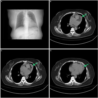 Case Report: A case of primary pericardial mesothelioma treated with multimodal combined therapy